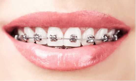 戴牙套能改善凸嘴吗？嘴凸可以戴牙套矫正吗？