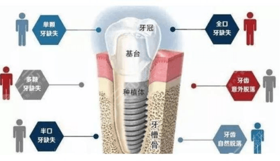 种植牙有要求吗？2022种植牙齿多少钱一个？附带各个种植体价格表