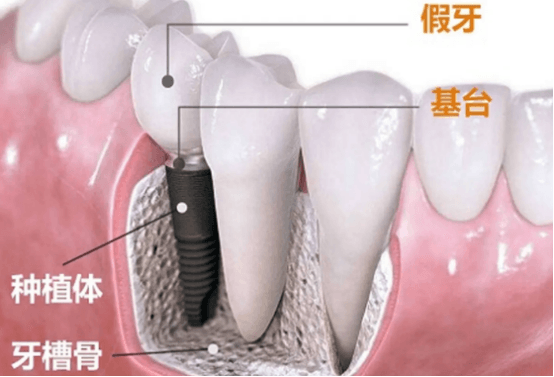 宁波种植牙大概多少钱一颗？瑞典诺贝尔种植体系统种牙要多少钱？