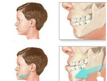 儿童牙齿天包地如何矫正 会影响牙根吗