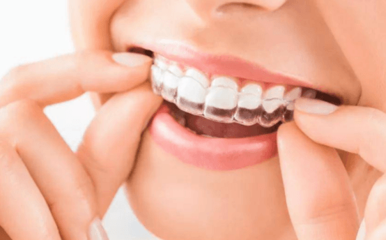 牙齿矫正橡皮圈的作用有哪些 矫正牙齿橡胶圈的作用