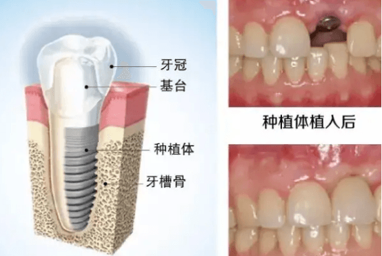 种牙和镶牙哪个危害大 镶牙和种牙的好处和坏处