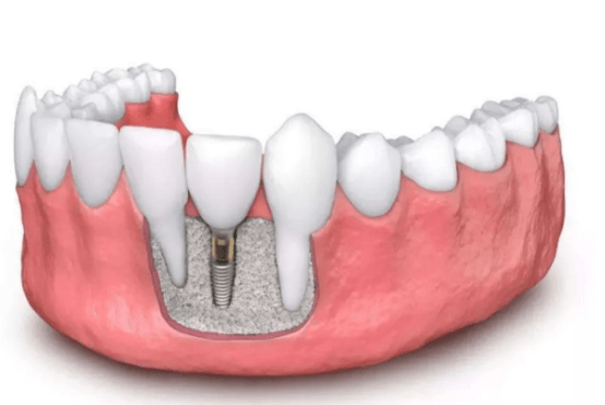 来月经能种植牙吗 大姨妈期间可以种牙吗