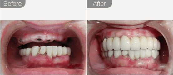 种植牙需要定期维护吗 种植牙需要维护保养吗
