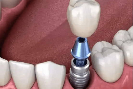 种牙挂口腔医院哪个科 种牙属于口腔什么科