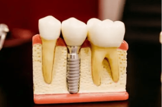 后牙适合什么种植体？试试这种材料对牙龈无损伤还耐磨