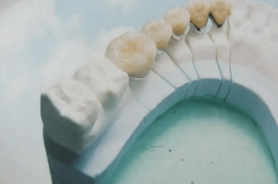 种植牙和打桩做牙冠的区别 打桩做牙冠是镶牙还是种植