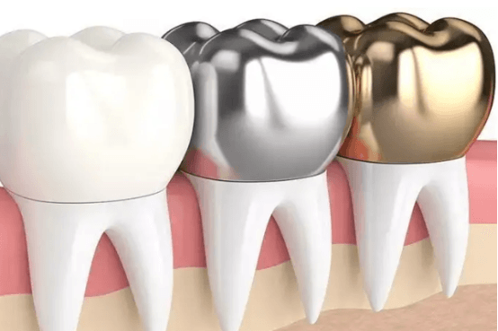 钴铬烤瓷牙和镍铬烤瓷牙区别 主要差异在于材质不同