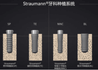 士卓曼种植体多少钱一颗 士卓曼种植体价格