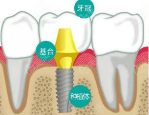 种植牙韩国植体价格 韩国牙种植体价格表