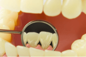 牙齿树脂贴面好不好 牙齿树脂贴面的好处与坏处