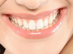 门牙牙缝大怎么修复 门牙牙缝大修复要多少钱？