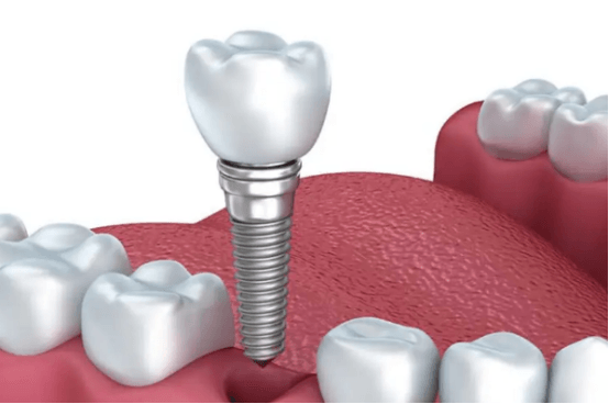 普通种植牙的价格