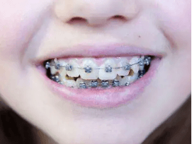 儿童几岁可以矫正牙齿?