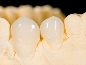 牙齿贴面材料有哪几种类型